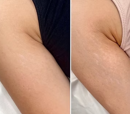 inkless-scar-revision