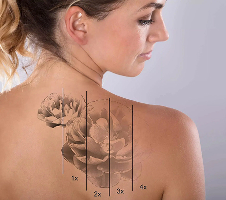 skin-tatoo-removal