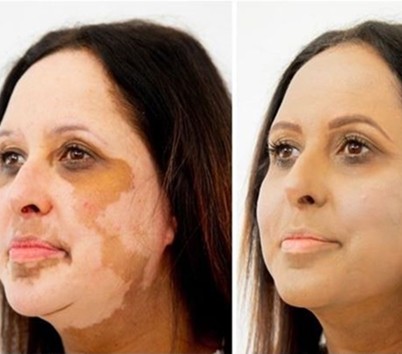 vitiligo-medical-tattoing